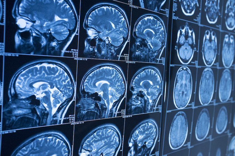 Understanding Common Types of Traumatic Brain Injuries