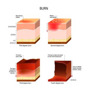 What Burn Injuries Can a Lawyer Help Me With?