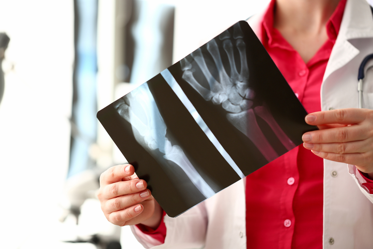Bone Fracture & Broken Bones Attorney | Zayed Law Offices Personal ...